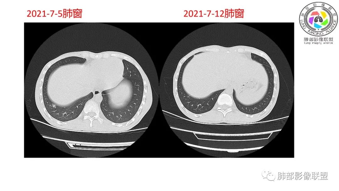 影像PPT - 【病例】马尔尼菲青霉菌病1例肺部CT影像-67 影像PPT - 【病例】马尔尼菲青霉菌病1例肺部CT影像-67