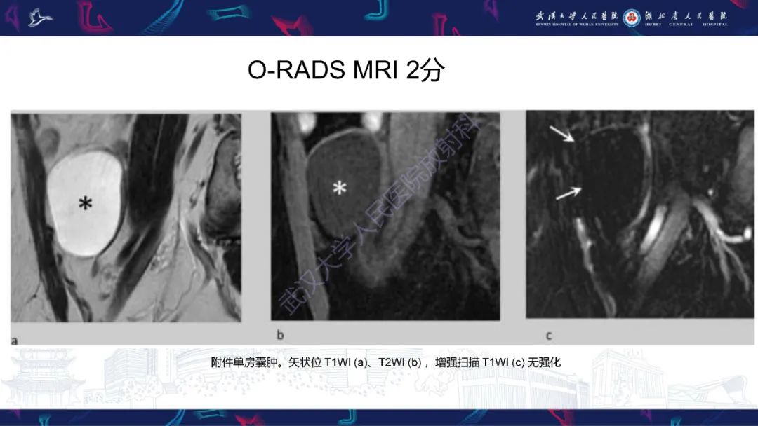 影像PPT - 【PPT】卵巢病变 O-RADS MRI评分解读-18