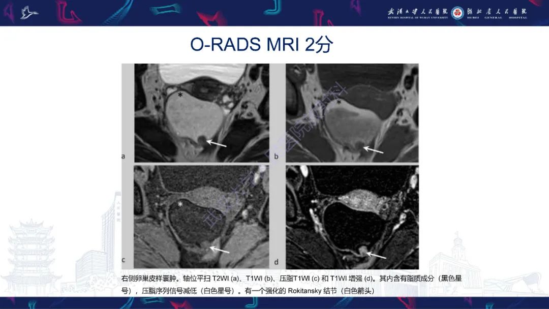 影像PPT - 【PPT】卵巢病变 O-RADS MRI评分解读-20