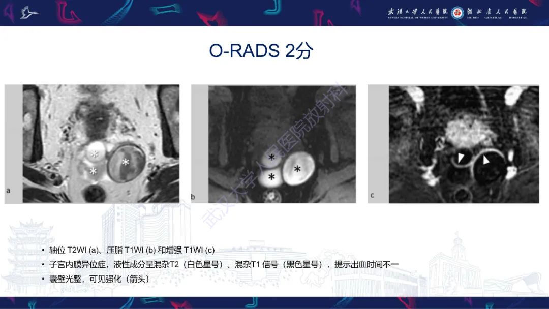 影像PPT - 【PPT】卵巢病变 O-RADS MRI评分解读-23