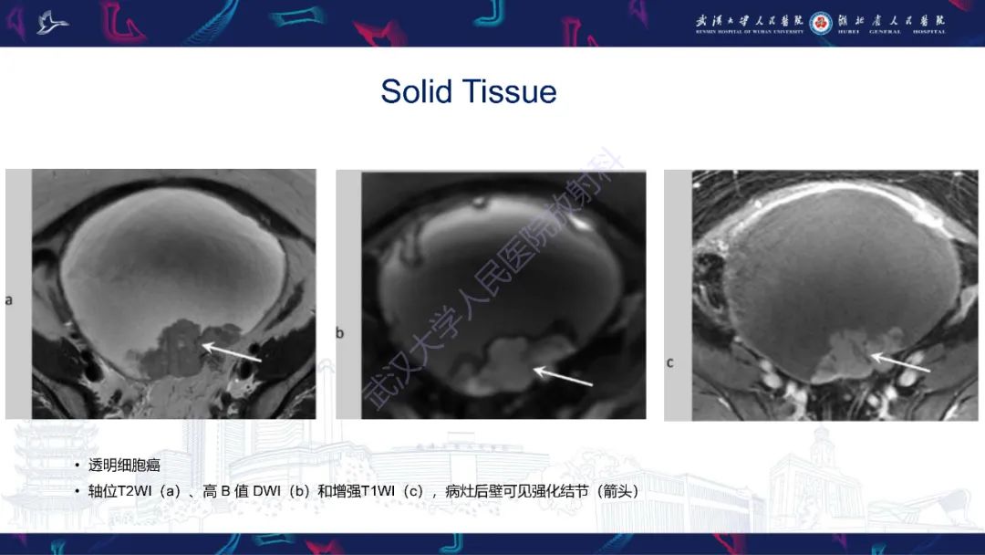 影像PPT - 【PPT】卵巢病变 O-RADS MRI评分解读-26