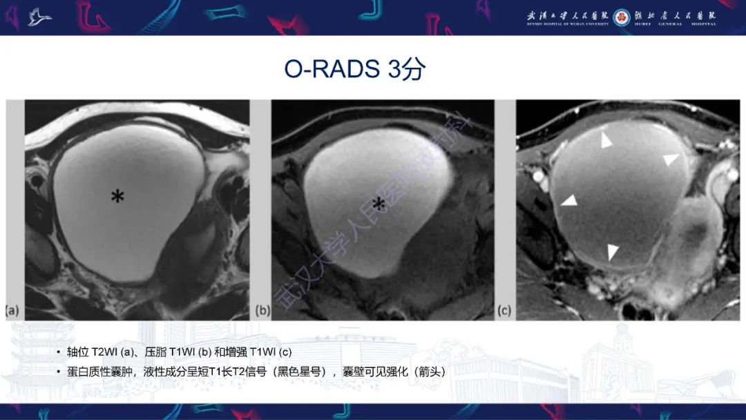 影像PPT - 【PPT】卵巢病变 O-RADS MRI评分解读-24