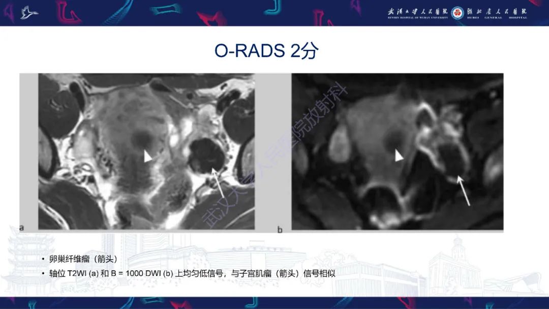 影像PPT - 【PPT】卵巢病变 O-RADS MRI评分解读-28