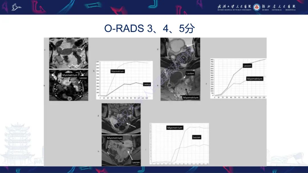 影像PPT - 【PPT】卵巢病变 O-RADS MRI评分解读-30