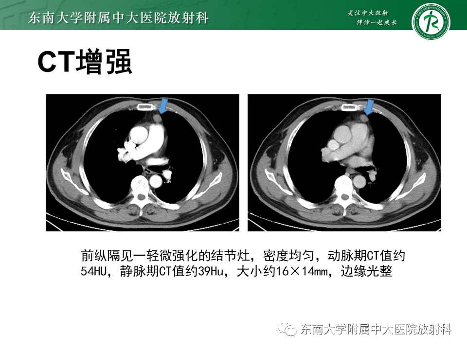 影像PPT - 【PPT】胸腺上皮肿瘤-2
