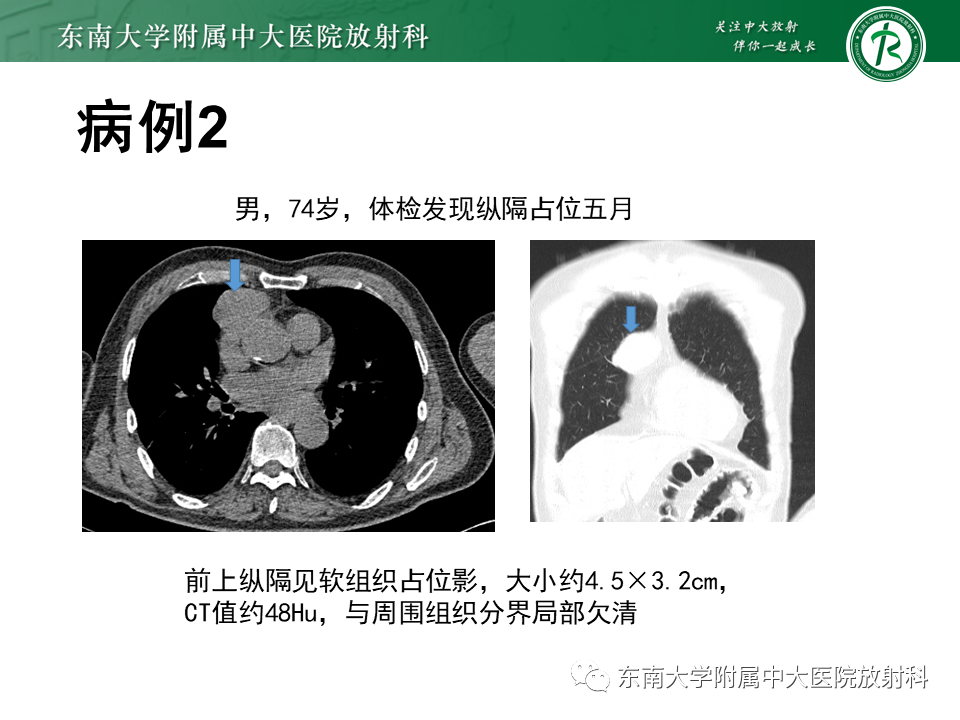 影像PPT - 【PPT】胸腺上皮肿瘤-12