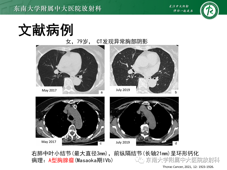 影像PPT - 【PPT】胸腺上皮肿瘤-14