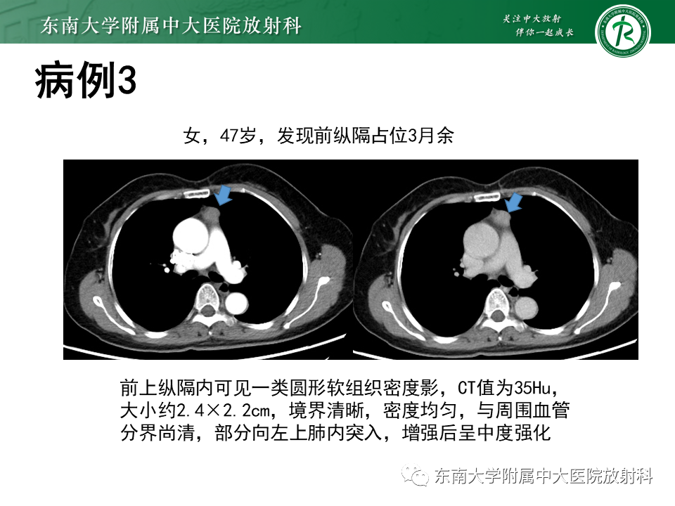 影像PPT - 【PPT】胸腺上皮肿瘤-16