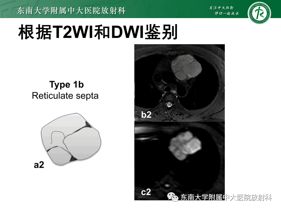 影像PPT - 【PPT】胸腺上皮肿瘤-20