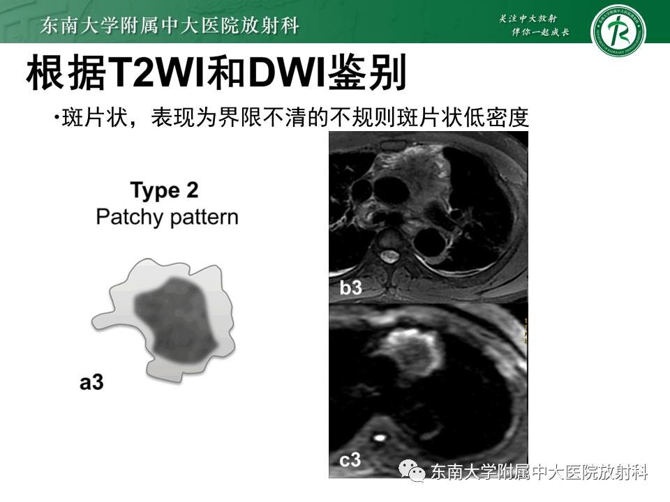 影像PPT - 【PPT】胸腺上皮肿瘤-21