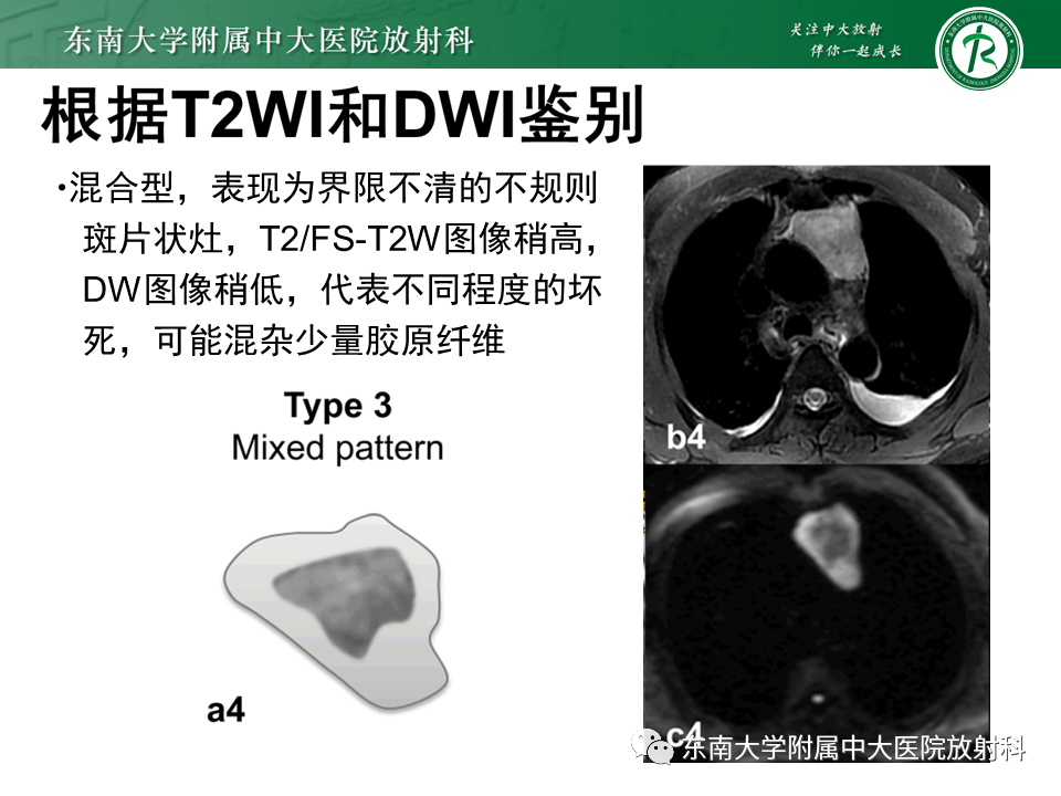 影像PPT - 【PPT】胸腺上皮肿瘤-22