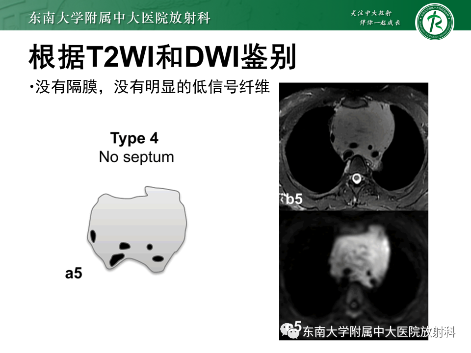 影像PPT - 【PPT】胸腺上皮肿瘤-23