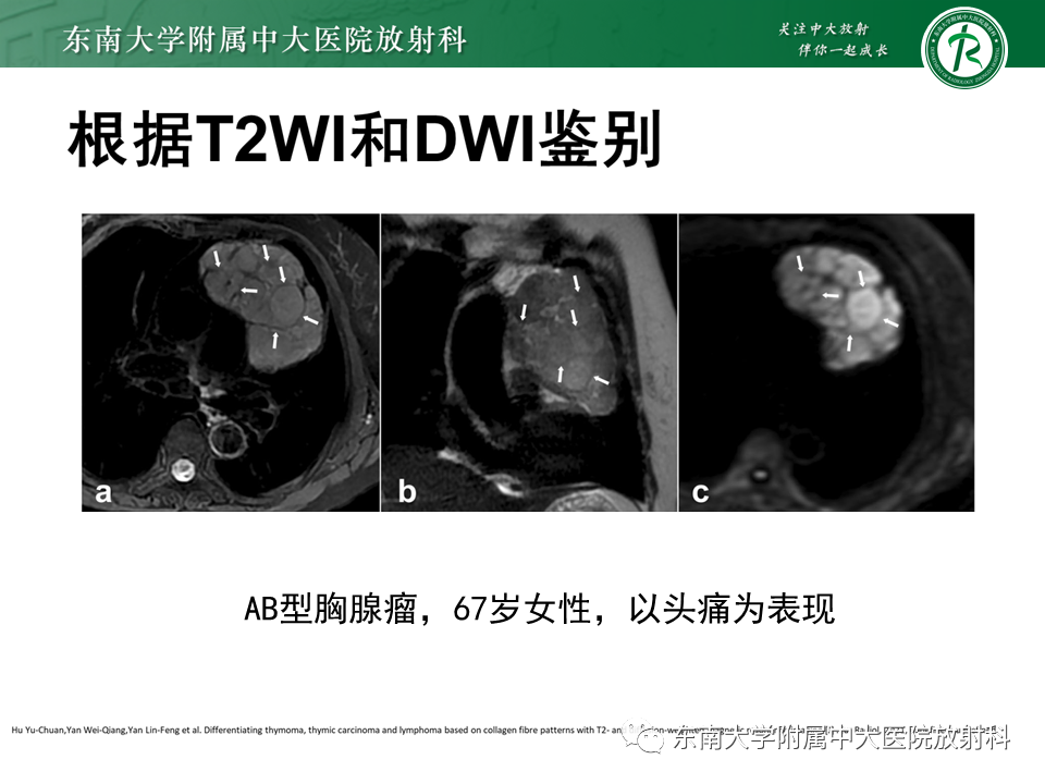 影像PPT - 【PPT】胸腺上皮肿瘤-24