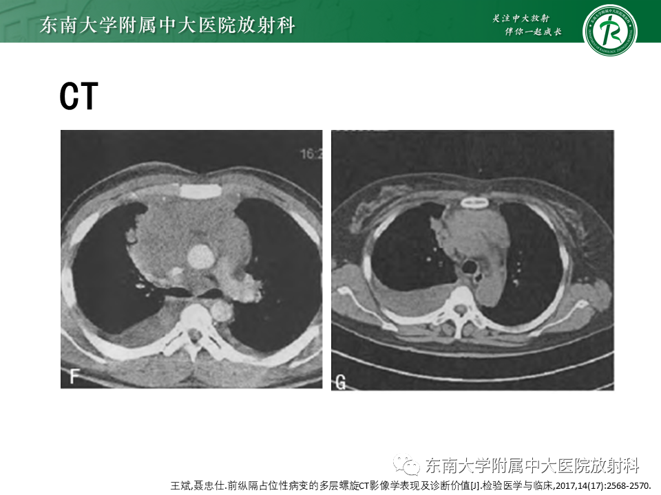 影像PPT - 【PPT】胸腺上皮肿瘤-27