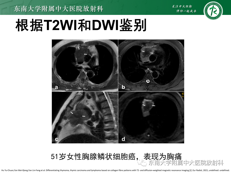 影像PPT - 【PPT】胸腺上皮肿瘤-25