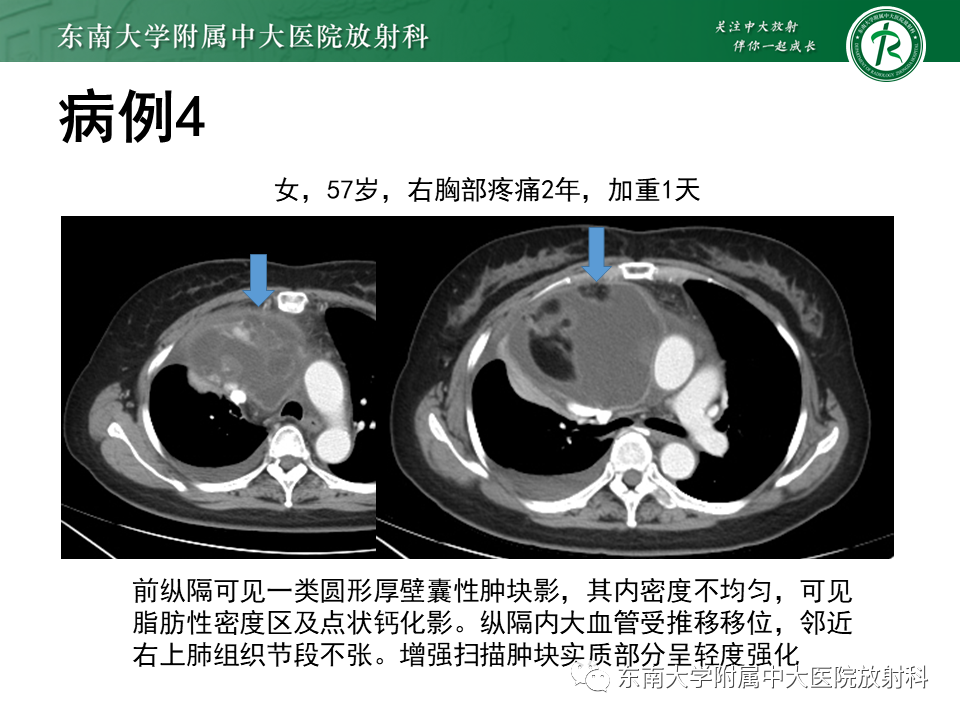 影像PPT - 【PPT】胸腺上皮肿瘤-29