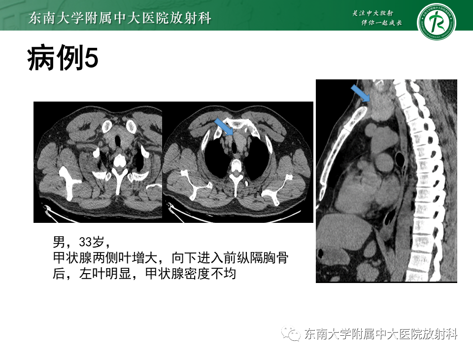 影像PPT - 【PPT】胸腺上皮肿瘤-34