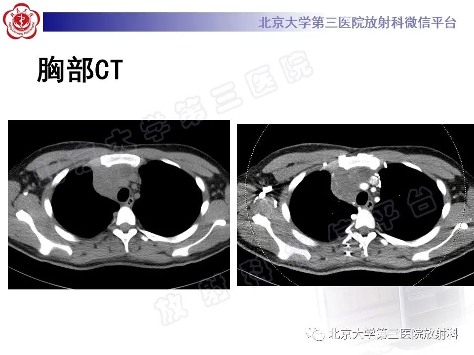 影像PPT - 【PPT】原发性纵隔卵黄囊瘤-3