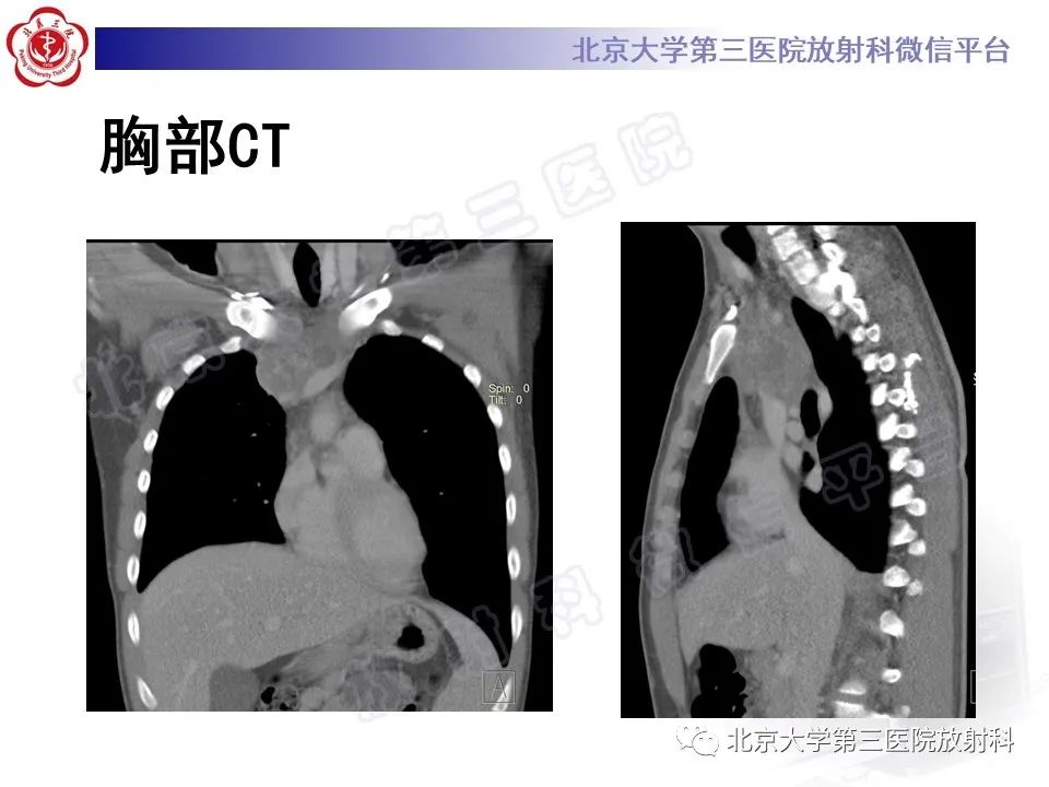影像PPT - 【PPT】原发性纵隔卵黄囊瘤-4