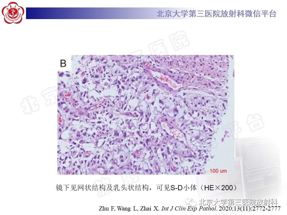 影像PPT - 【PPT】原发性纵隔卵黄囊瘤-11