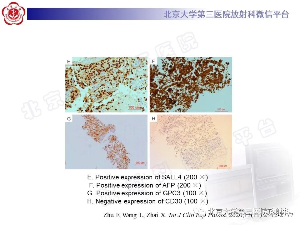影像PPT - 【PPT】原发性纵隔卵黄囊瘤-13