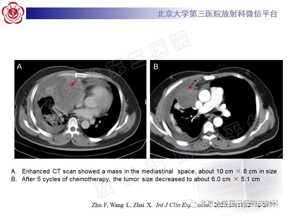 影像PPT - 【PPT】原发性纵隔卵黄囊瘤-17