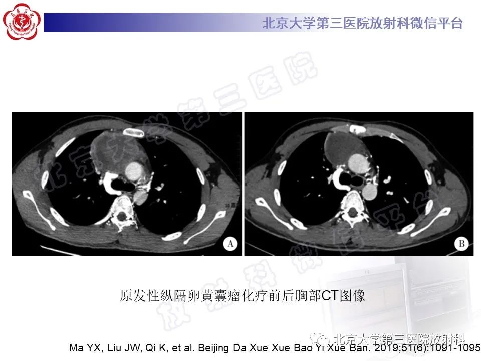 影像PPT - 【PPT】原发性纵隔卵黄囊瘤-18