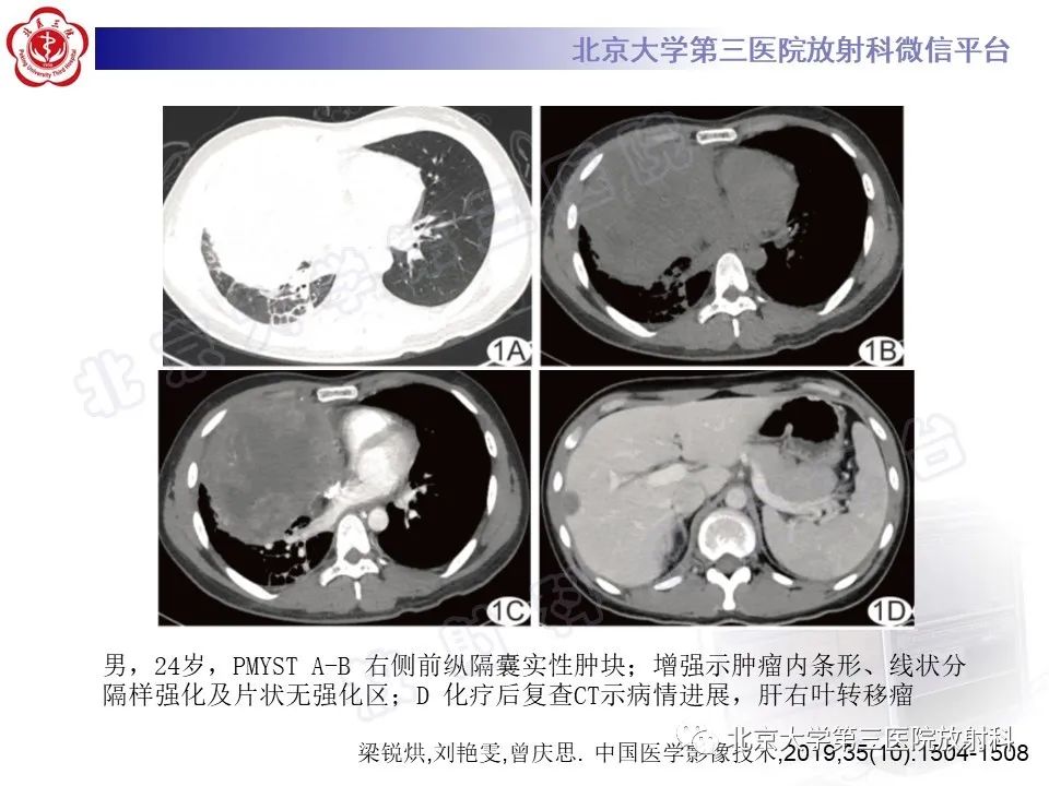 影像PPT - 【PPT】原发性纵隔卵黄囊瘤-19