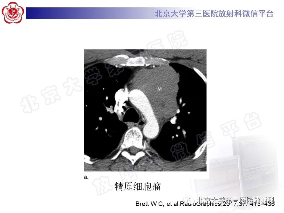 影像PPT - 【PPT】原发性纵隔卵黄囊瘤-22