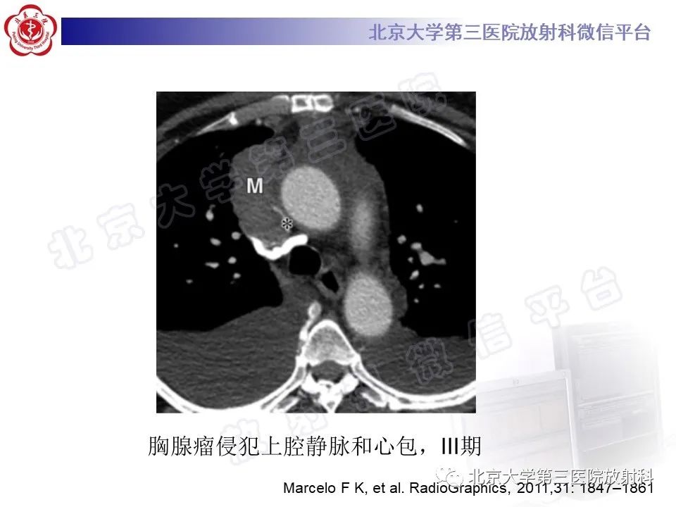 影像PPT - 【PPT】原发性纵隔卵黄囊瘤-24