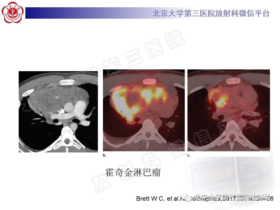 影像PPT - 【PPT】原发性纵隔卵黄囊瘤-26