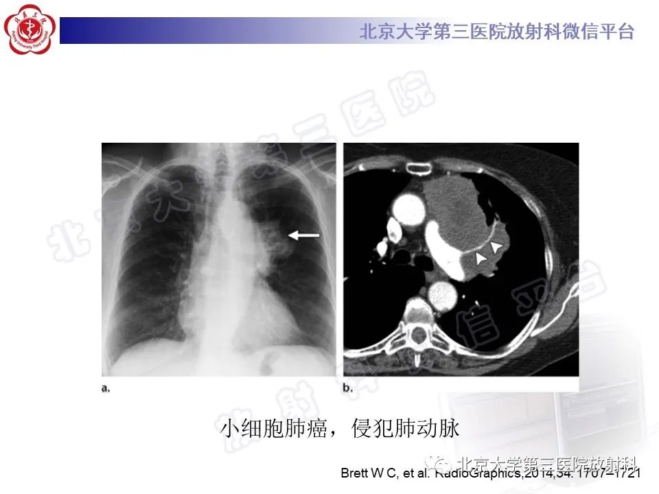 影像PPT - 【PPT】原发性纵隔卵黄囊瘤-28