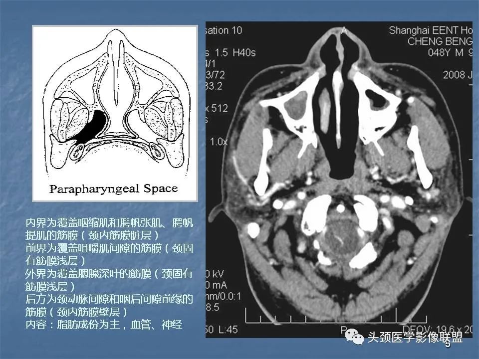 影像PPT - 【PPT】咽旁间隙与咽旁肿瘤的影像诊断-5