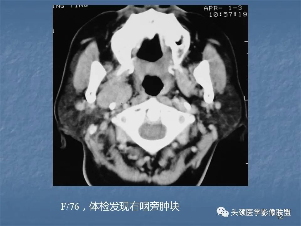 影像PPT - 【PPT】咽旁间隙与咽旁肿瘤的影像诊断-12
