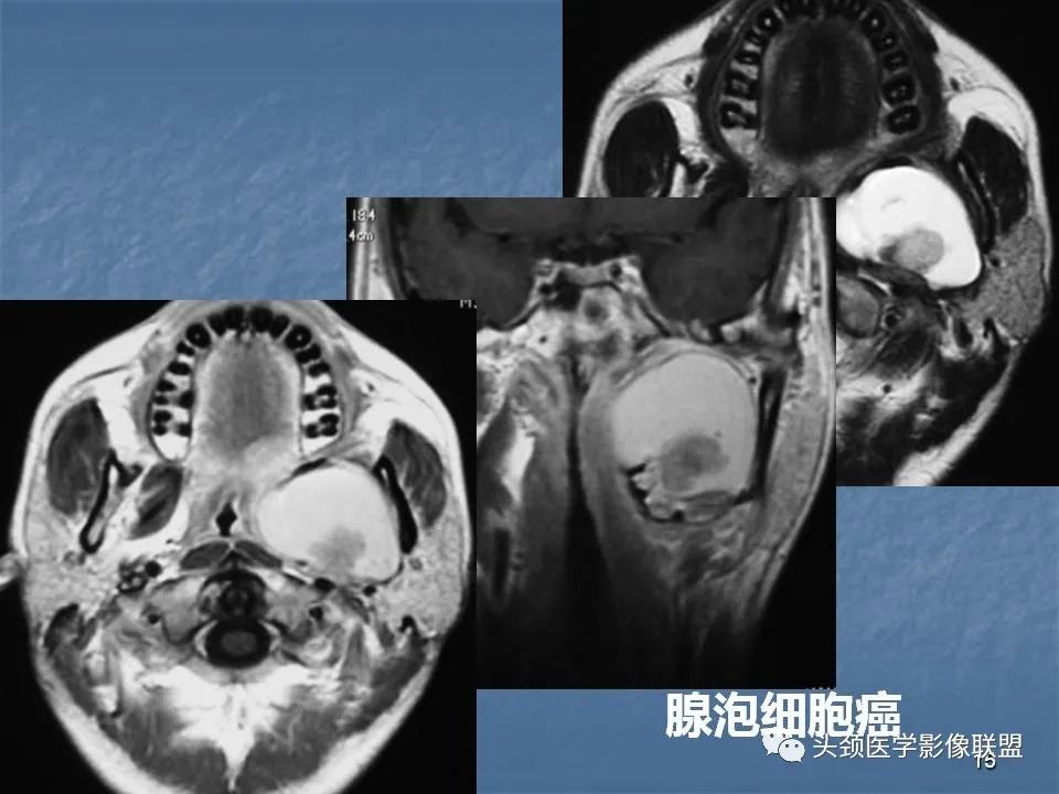影像PPT - 【PPT】咽旁间隙与咽旁肿瘤的影像诊断-15