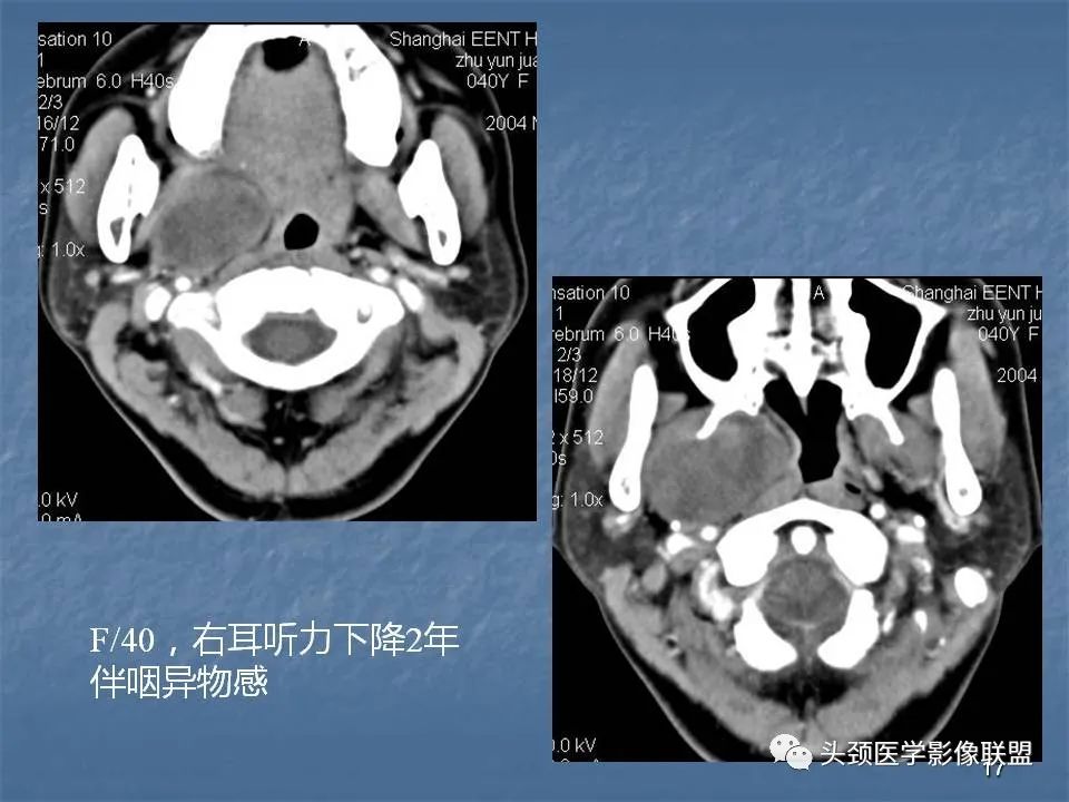 影像PPT - 【PPT】咽旁间隙与咽旁肿瘤的影像诊断-17