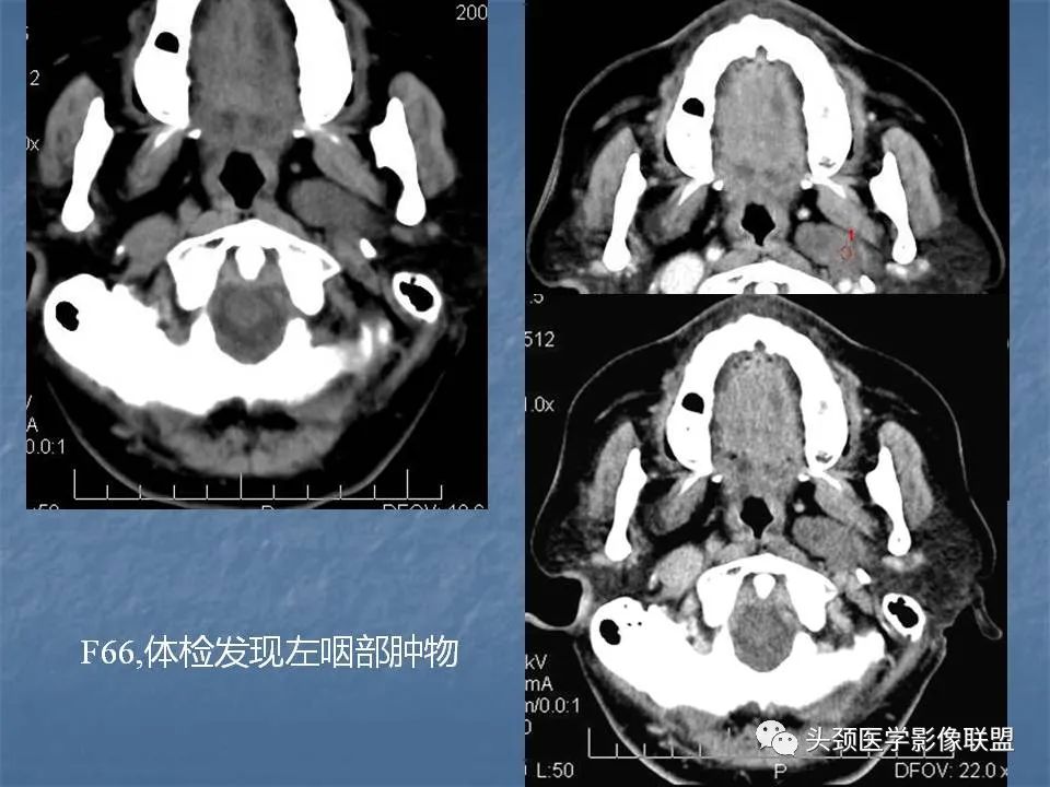 影像PPT - 【PPT】咽旁间隙与咽旁肿瘤的影像诊断-21