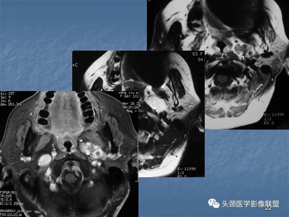 影像PPT - 【PPT】咽旁间隙与咽旁肿瘤的影像诊断-22