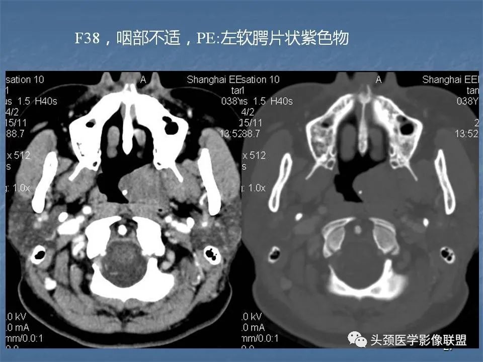 影像PPT - 【PPT】咽旁间隙与咽旁肿瘤的影像诊断-27