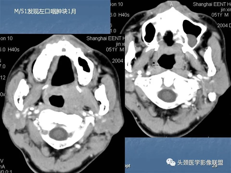 影像PPT - 【PPT】咽旁间隙与咽旁肿瘤的影像诊断-29