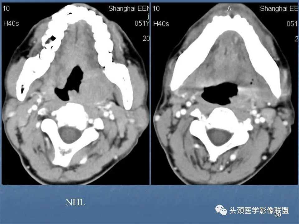 影像PPT - 【PPT】咽旁间隙与咽旁肿瘤的影像诊断-30