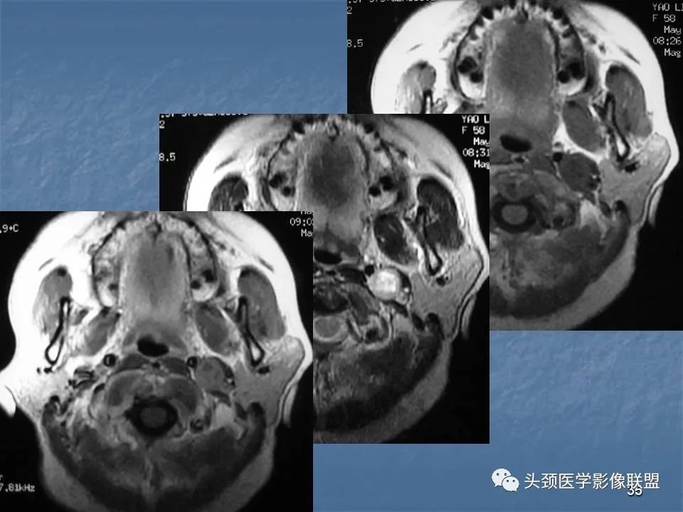 影像PPT - 【PPT】咽旁间隙与咽旁肿瘤的影像诊断-35