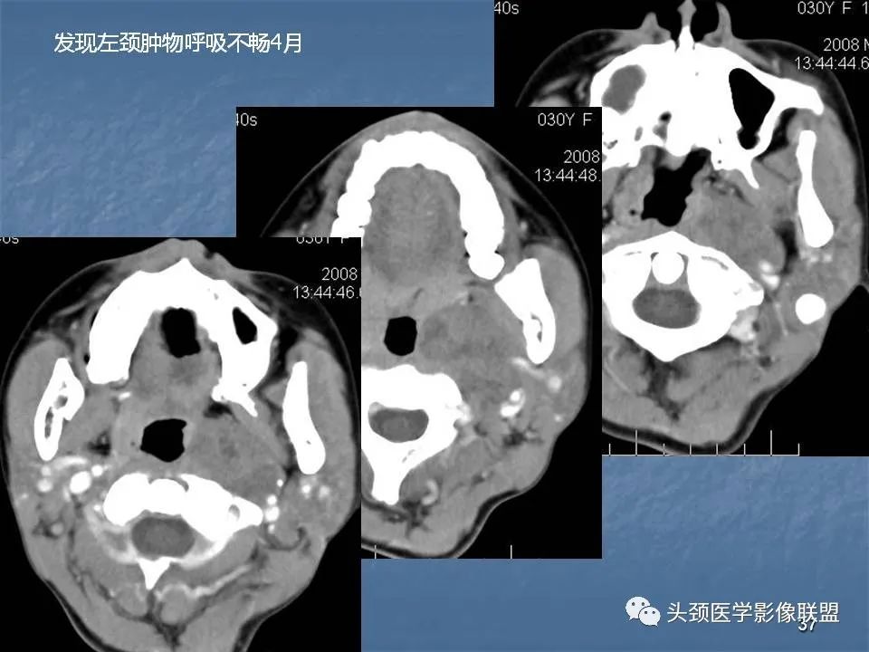 影像PPT - 【PPT】咽旁间隙与咽旁肿瘤的影像诊断-37