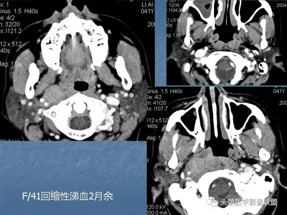 影像PPT - 【PPT】咽旁间隙与咽旁肿瘤的影像诊断-41