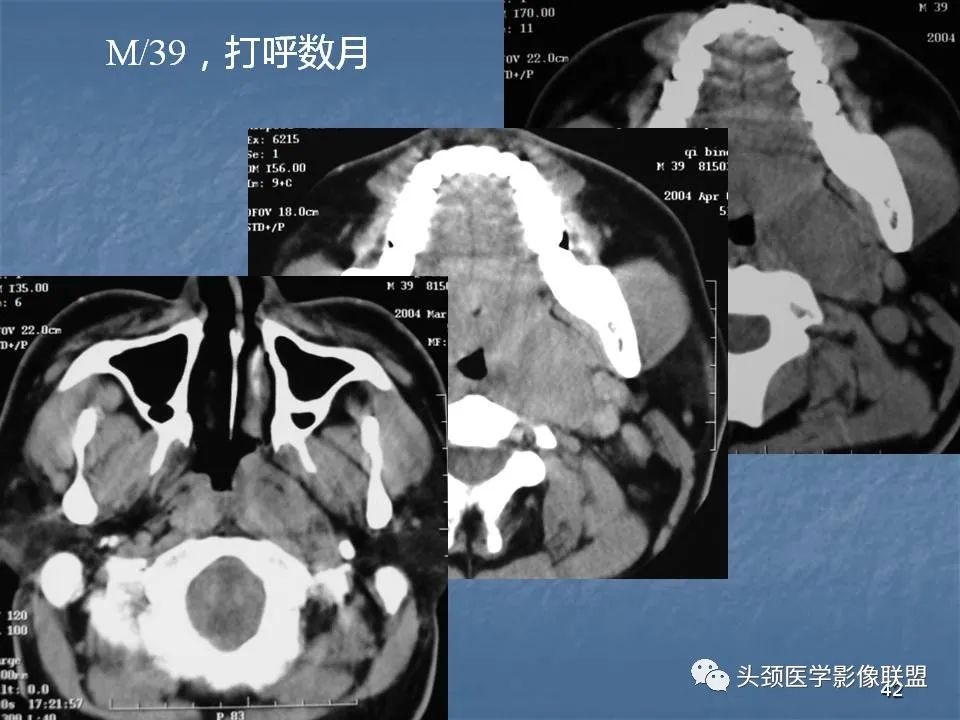 影像PPT - 【PPT】咽旁间隙与咽旁肿瘤的影像诊断-42