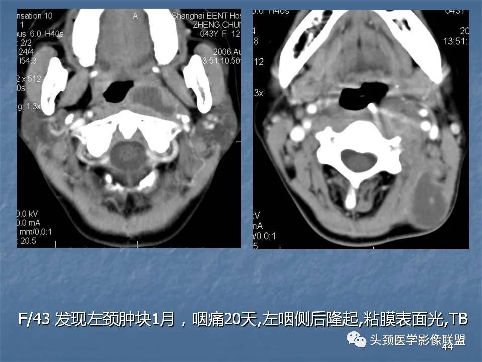 影像PPT - 【PPT】咽旁间隙与咽旁肿瘤的影像诊断-44