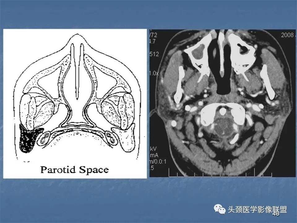 影像PPT - 【PPT】咽旁间隙与咽旁肿瘤的影像诊断-46