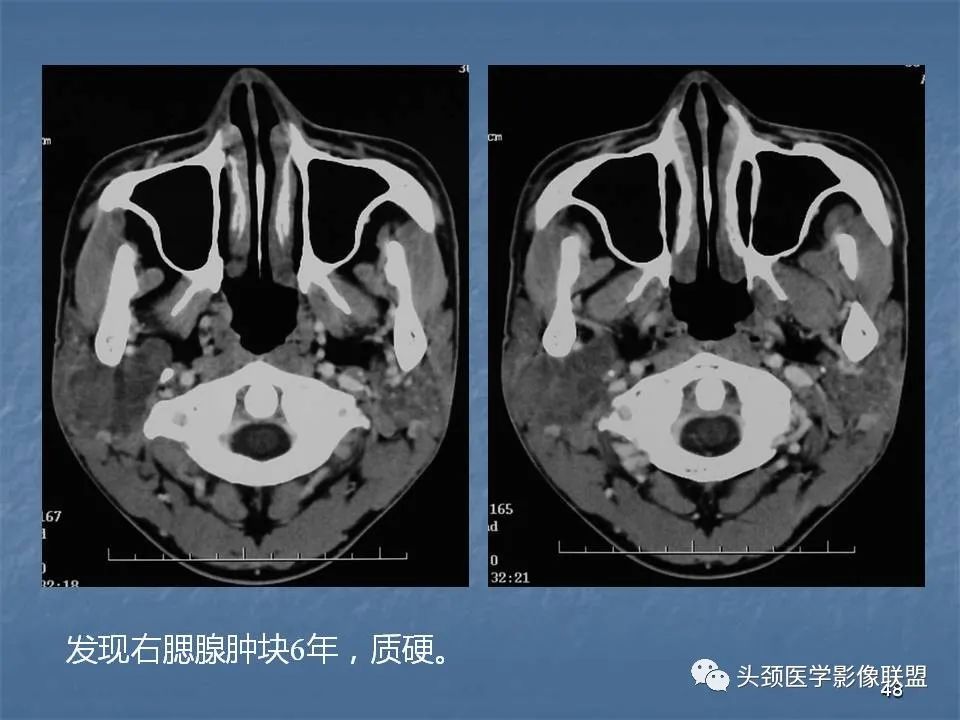 影像PPT - 【PPT】咽旁间隙与咽旁肿瘤的影像诊断-48