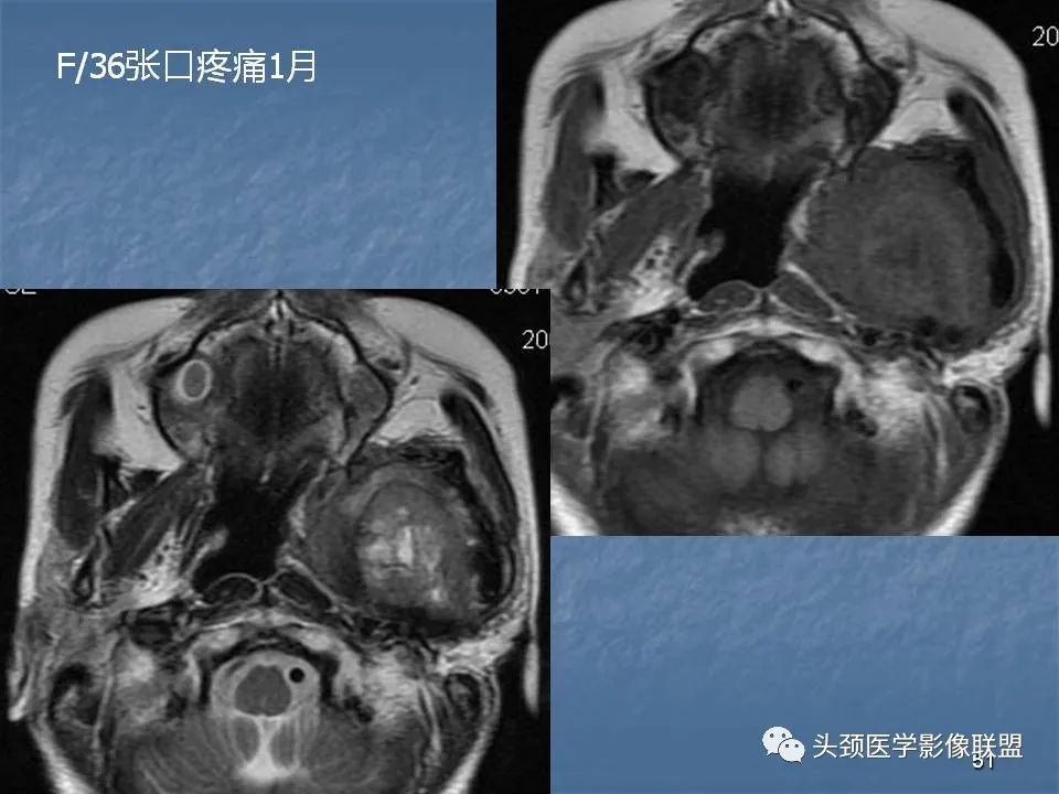 影像PPT - 【PPT】咽旁间隙与咽旁肿瘤的影像诊断-51