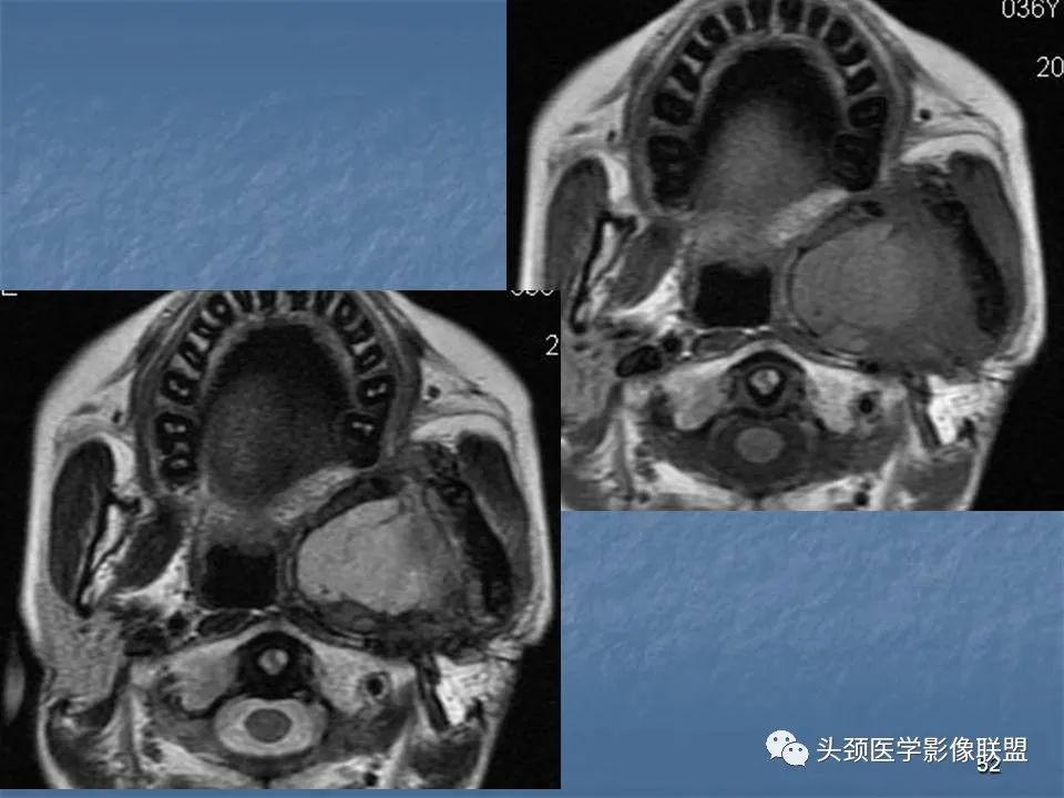 影像PPT - 【PPT】咽旁间隙与咽旁肿瘤的影像诊断-52